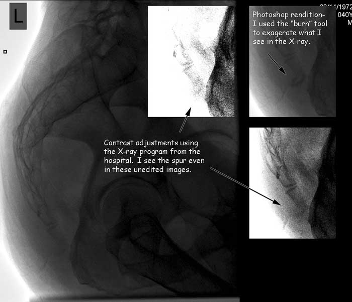 coccyx x-ray